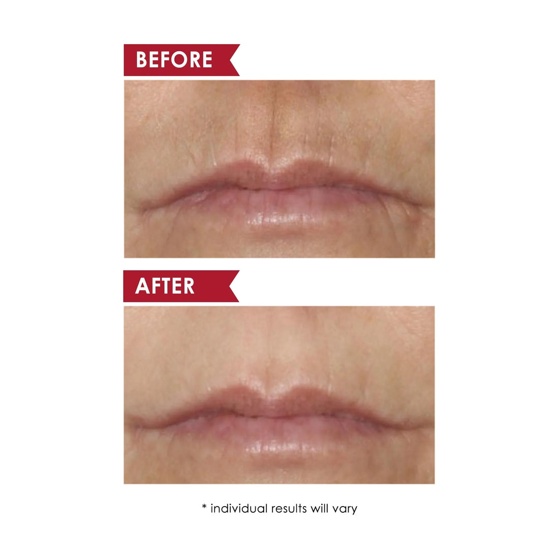 Smooth Upper Lip Perioral Anti-Aging Treatment - Professional